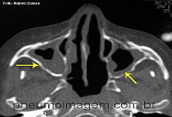 REVISÃO APONTA OS MELHORES DISPOSITIVOS E TÉCNICAS DE APLICAÇÃO DE MEDICAMENTOS NASAIS. REVISÃO APONTA OS MELHORES DISPOSITIVOS E TÉCNICAS DE APLICAÇÃO DE MEDICAMENTOS NASAIS.